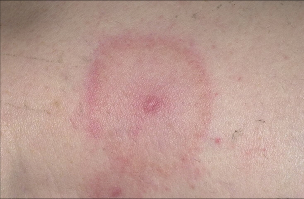 Россия столкнулась с новой угрозой: растет число клещей, зараженных риккетсиозом